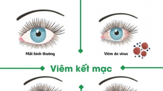 Chú ý dịch đau mắt đỏ trong thời tiết nóng ẩm