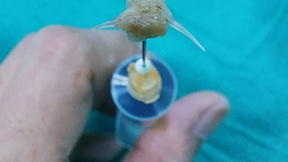 Nghệ An nội soi gắp dị vật là mảnh xương cá ra khỏi đường thở của bệnh nhi 2 tuổi