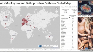 Những điều cần biết về bệnh đậu mùa khỉ