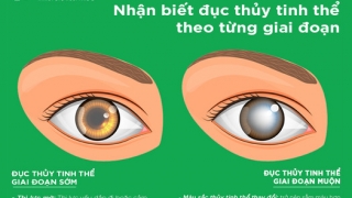 Nhận biết đục thủy tinh thể theo từng giai đoạn