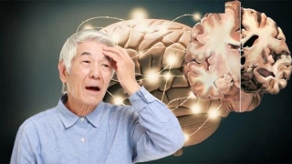 Điều trị bệnh Alzheimer bằng một số bài thuốc y học cổ truyền