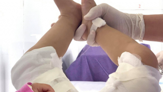 Bỏng gây đau đớn, mất thẩm mỹ và tâm lý bất ổn cho trẻ nhỏ