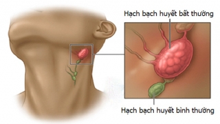 Cách nhận biết sưng hạch ở trẻ em