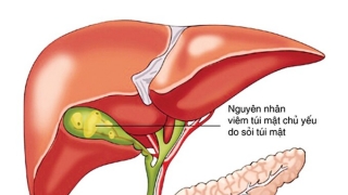 Chuyên gia cho rằng 90% viêm túi mật có nguyên nhân do sỏi túi mật