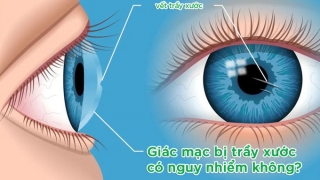 Giác mạc bị trầy xước có nguy hiểm không?