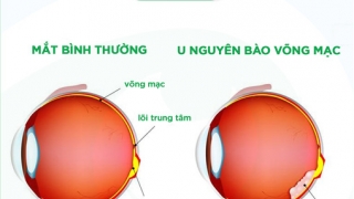 Bệnh u nguyên bào võng mạc là gì?