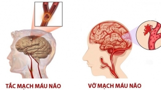 Nguyên nhân, dấu hiệu nhận biết và cách sơ cứu đột quỵ não