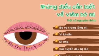 Những điều cần biết về viêm bờ mi