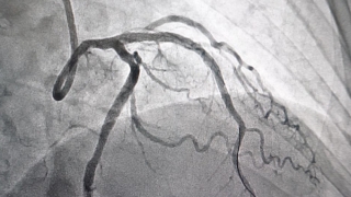 Đột phá trong việc đặt stent động mạch vành