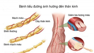 Vì sao bệnh tiểu đường lại gây hoại tử bàn chân?