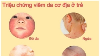 Bệnh lý viêm da cơ địa ở trẻ nhỏ