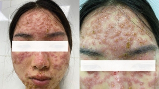 Hà Nội: Cô gái bị nhiễm Eczema herpesticum do đắp mặt 'detox' tại spa