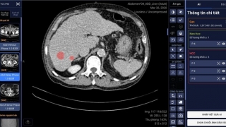 VinBrain hợp tác với Bệnh viện Đại học Y dược TP. HCM phát triển ứng dụng AI phát hiện, chẩn đoán ung thư gan