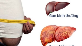 Hai dấu hiệu cảnh báo bệnh gan nhiễm mỡ ở chân và bụng