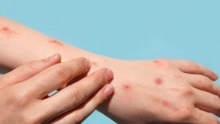 Bệnh đậu mùa khỉ được WHO đặt tên mới là 'mpox'