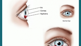 Triệu chứng, cách điều trị và các cấp độ của xuất huyết tiền phòng