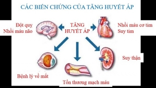 Tăng huyết áp - Âm thầm nhưng dễ gây ra biến chứng nguy hiểm