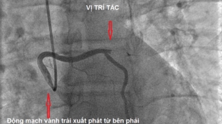 Hà Nội cấp cứu bệnh nhân nhồi máu cơ tim cấp có bất thường giải phẫu động mạch vành