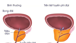 Thảo dược hỗ trợ điều trị phì đại tiền liệt tuyến