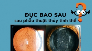 Đục bao sau sau phẫu thuật thủy tinh thể