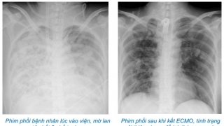 Hà Nội điều trị thành công cho bệnh nhân bị viêm phổi bội nhiễm, suy đa tạng do lạm dụng corticoid tự điều trị cúm