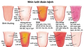 Nhìn lưỡi, chẩn bệnh cho bản thân