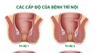 Bệnh trĩ gây ảnh hưởng từ 30 - 35% dân số nước ta