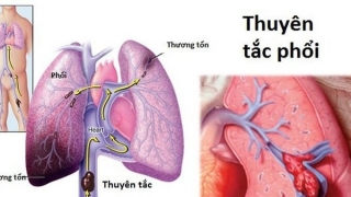 Các yếu tố nguy cơ, chẩn đoán, điều trị thuyên tắc phổi