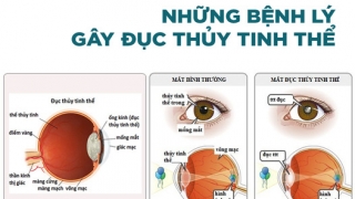 Những bệnh lý có thể gây đục thủy tinh thể