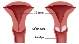 Những điều cần biết về vaccine HPV