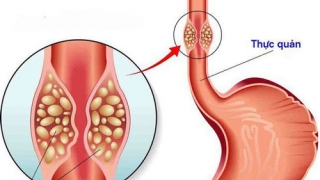 Quảng Ninh: Một bệnh nhân đi khám viêm họng phát hiện bị ung thư thực quản