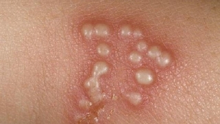 Tìm hiểu về bệnh herpes simplex