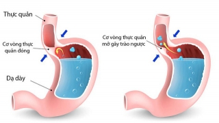 Mối quan hệ giữa trào ngược dạ dày thực quản và viêm loét dạ dày