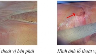 Thoát vị bẹn phát hiện và điều trị muộn có thể gây các biến chứng đe dọa đến tính mạng