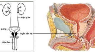 Những điều cần biết về bệnh ung thư tiền liệt tuyến ở nam giới