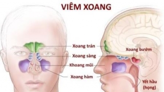 Mối liên quan giữa bệnh viêm xoang và viêm họng mạn tính