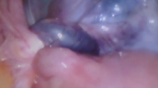 Nghệ An phẫu thuật cấp cứu thành công bệnh nhân bị u nang buồng trứng xoắn 3 vòng