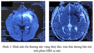 Một thanh niên 19 tuổi nguy kịch do bị viêm não