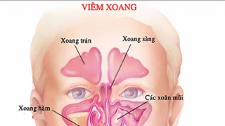 Những điều cần biết về viêm xoang trán