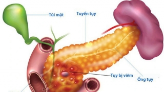 Viêm tụy cấp gây ra nhiều biến chứng ảnh hưởng lớn đến sức khỏe con người