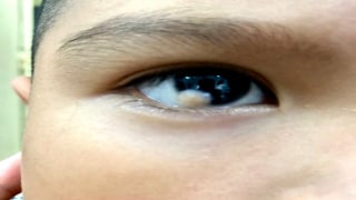 Tìm hiểu về u bì kết giác mạc