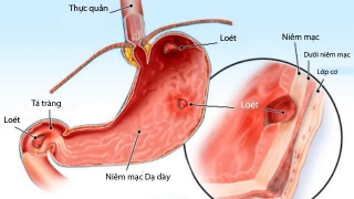 Triệu chứng và biến chứng viêm loét hành tá tràng