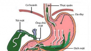 Mối quan hệ giữa trào ngược dịch mật và trào ngược dạ dày thực quản