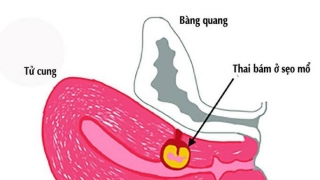 Cao Bằng phẫu thuật lấy khối thai bám sẹo mổ cũ cho thai phụ 27 tuổi