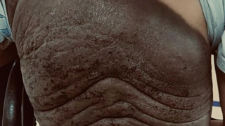 Phẫu thuật tạo hình cho 2 bé trai mắc Nevus (Nơvi) hắc tố bẩm sinh khổng lồ