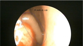 Tuyên Quang gắp thành công một con vắt trong mũi nam bệnh nhân bằng phương pháp nội soi