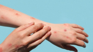 WHO tuyên bố bệnh đậu mùa khỉ không còn là tình trạng khẩn cấp về y tế công cộng