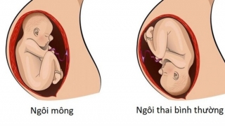 Tìm hiểu về liệt đám rối thần kinh cánh tay