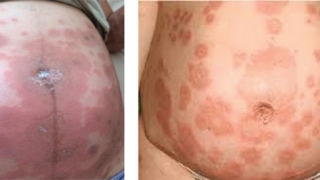 Pemphigoid thai kì là bệnh lý bọng nước tự miễn hiếm gặp