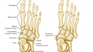 Điều trị xương thuyền phụ cần kết hợp thuốc và vật lý trị liệu